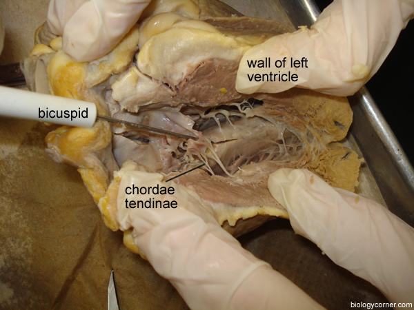 heart bicuspid