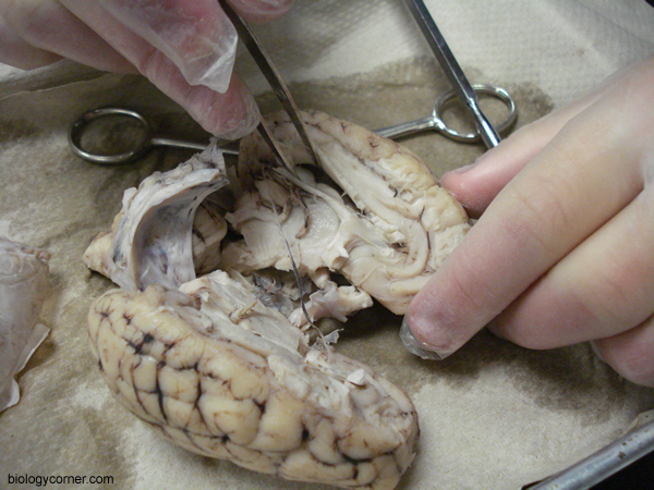 lateral ventricle
