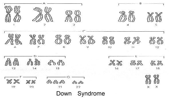 Down's Syndrome ( Trisomy #21)