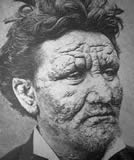 man with leprosy