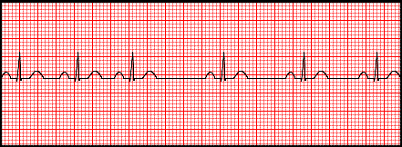 Ecg