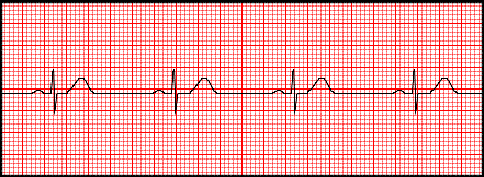 Ecg