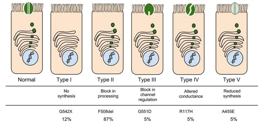 cystic fibrosis case study biology corner