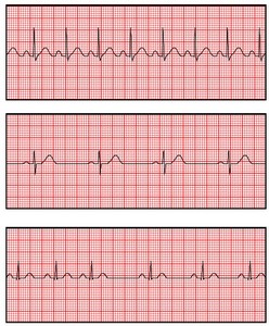 ecg