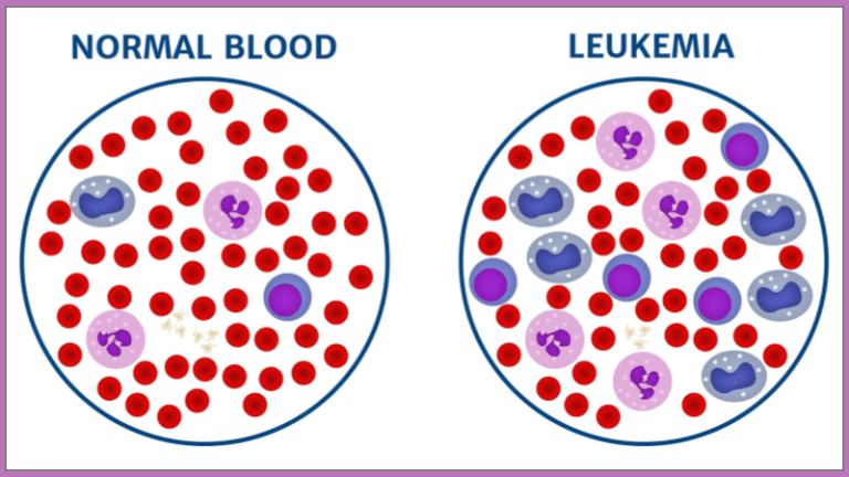 leukemia-the-biology-corner