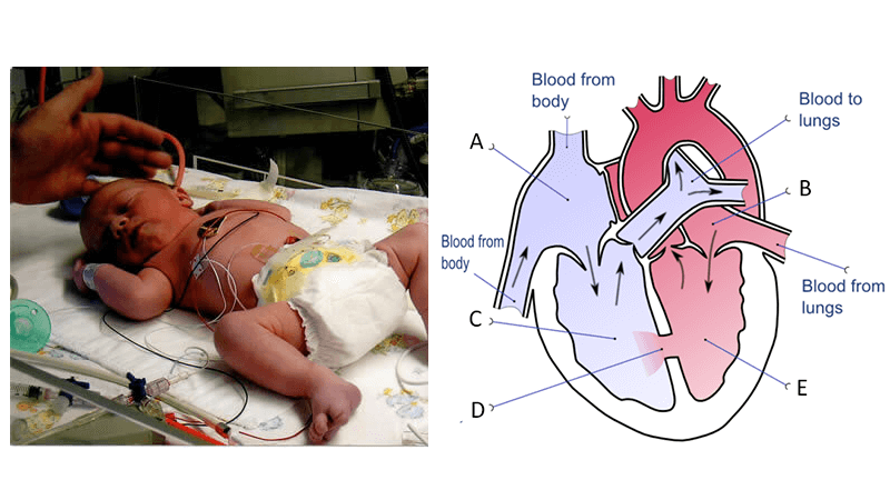 Updated Case – A Tiny Heart (Ross Procedure)